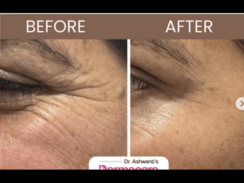 Botox & Fillers