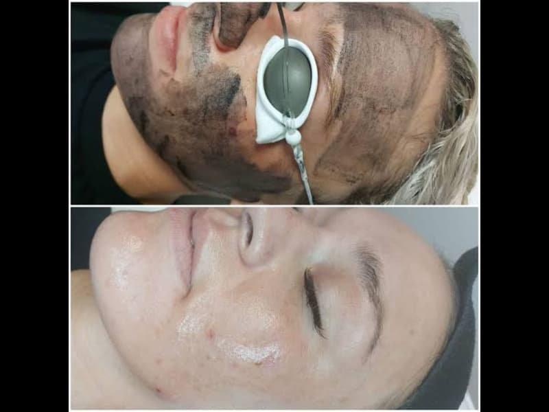 Chemical Peels